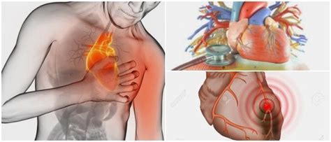 Infarto Al Miocardio ¿qué Es Síntomas Comorbilidades Asociadas Diagnóstico Causas Y