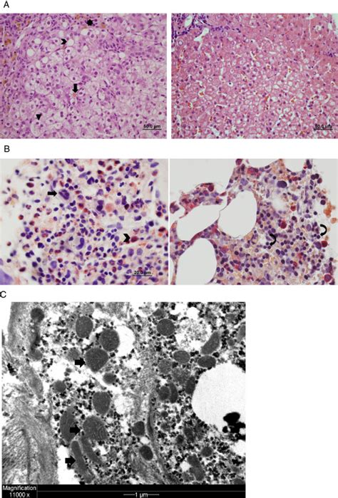 Liver And Bone Marrow Pathology A The Patient’s Bone Marrow Left Download Scientific Diagram