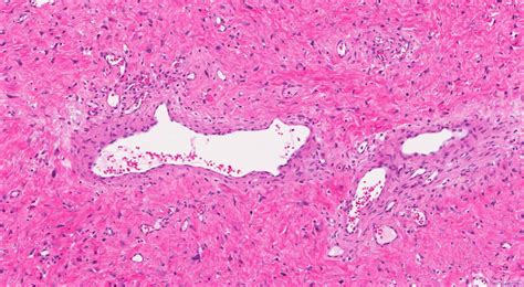 Nasopharyngeal Angiofibroma Archives Atlas Of Pathology