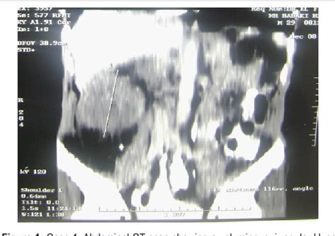 Figure 1 From Adult Wilms Tumour A Rare Presentation Of Two Case