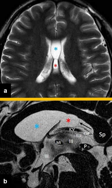 Axial T2 Weighted Magnetic Resonance Images At The Lowest Level Of The