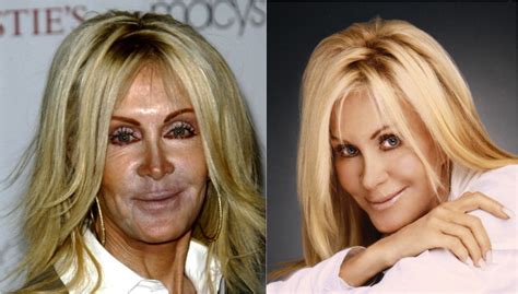 Celebrity Plastic Surgery - Is it Just Bad Photos?!