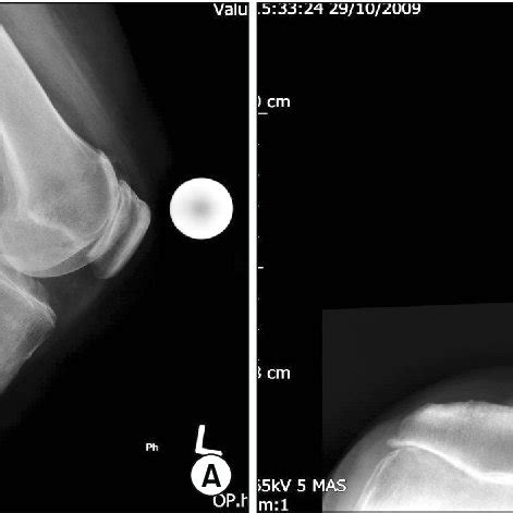 (PDF) Patellofemoral Joint Arthroplasty: Early results and functional ...