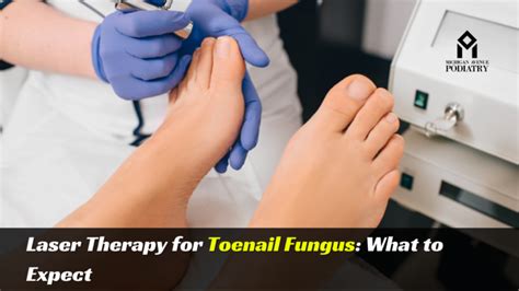 Laser Therapy For Toenail Fungus What To Expect