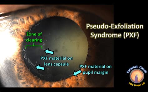 Cataract Surgery In Pseudo Exfoliation Syndrome Cataract Coach