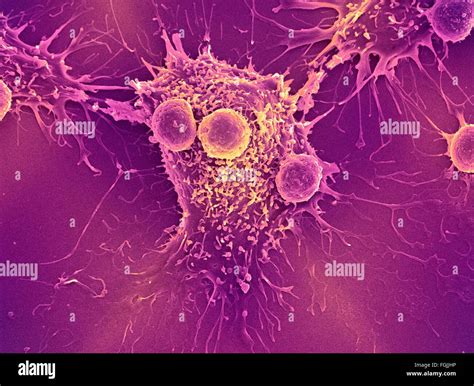 T Lymphocytes And Cancer Cell Coloured Scanning Electron Micrograph