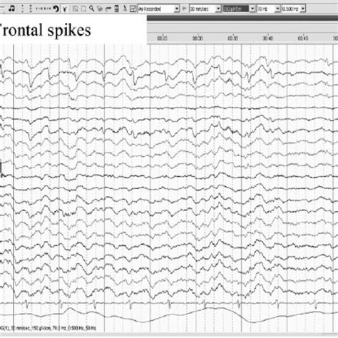 Interictal EEG Recording On Patient 1 Demonstrating Frontal Spikes