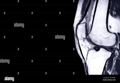 Compare Of Mri Knee Joint Or Magnetic Resonance Imaging Sagital View