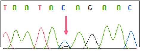 Dna Sequence Analysis Of Mlh1 Reveals A Heterozygous Splicing Mutation