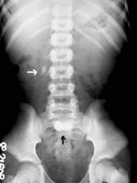 Kidney Stone Xray