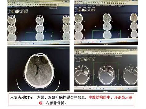 轻型颅脑损伤致顽固性颅内压增高2例丨颅脑创伤 神经重症病例周刊（第55期） 脑医汇 神外资讯 神介资讯