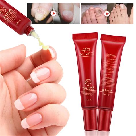 Aliexpress.com : Buy Good Result Toe Nail Fungus Treatment Cream ...