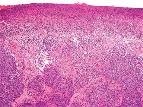 Nodular Melanoma Histology