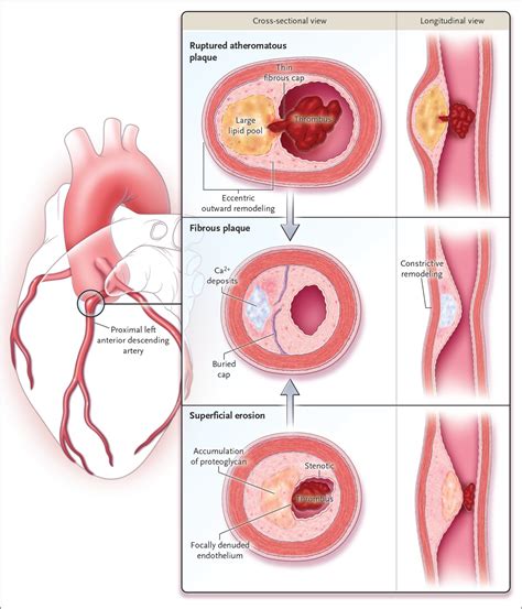 Mechanisms Of Acute Coronary Syndromes And Their Implications For