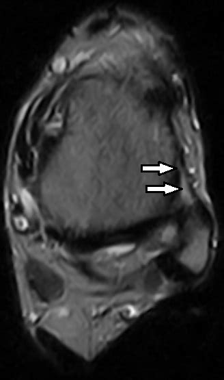 Ankle Sprain Mri