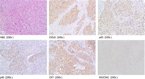 The Expression Of Ck5 6 P63 P40 Ck7 And Muc5ac In A Case Of