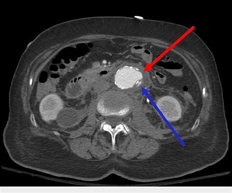 PDF Penetrating Aortic Ulceration With Pseudoaneurysm And Intramural