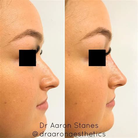 Non Surgical Rhinoplasty Purpose To Hide Bumps Straighten Your Nose