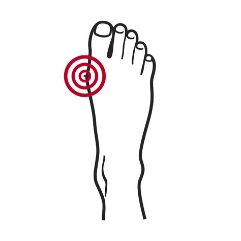 Bunions - Netstep