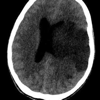 -Non contrast CT axial slice at the basal ganglia level demonstrating a ...