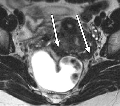 Anatomic Distribution Of Posterior Deeply Infiltrating Endometriosis On Mri After Vaginal And