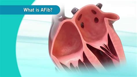 An Overview Of Atrial Fibrillation Youtube