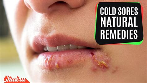 10 Most Effective Natural Home Remedies For Cold Sores Youtube