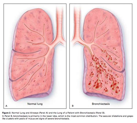 Bronchiectasis Physiopedia