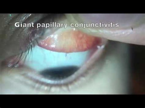 Giant Papillary Conjunctivitis YouTube