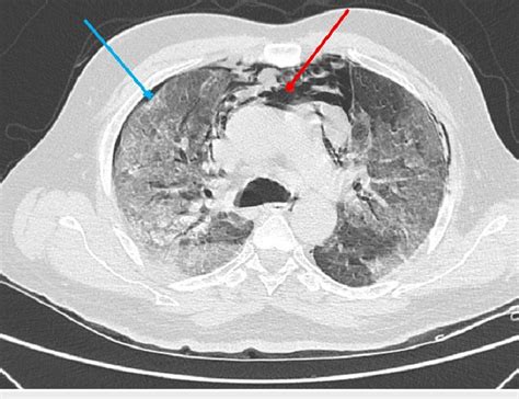 High Resolution Computed Tomography Of The Thorax Axial Section Showing