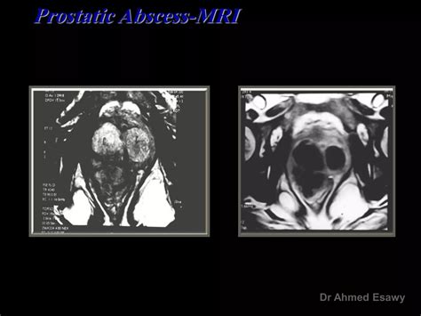 Imaging Prostatitis Urethritis Dr Ahmed Esawy Ppt