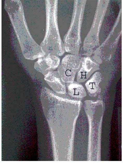 Plain Postero Anterior Radiograph Of The Wrist Showing A Type II