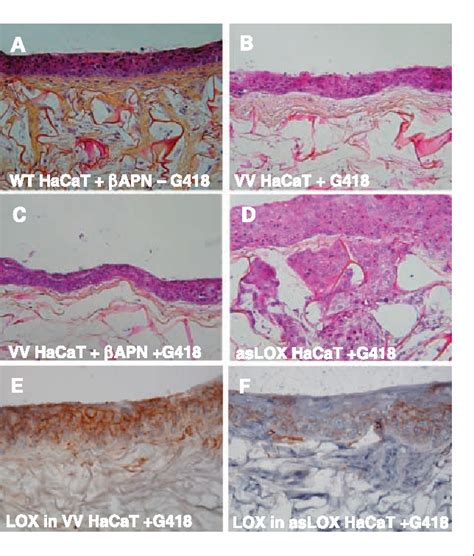 Figure 5 From The Lysyl Oxidase LOX Is Absent In Basal And Squamous