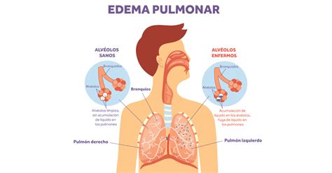 L Quido En Los Pulmones Causas Y Tratamiento Eakin Respiratory