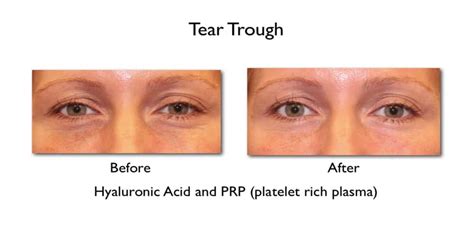 Under Eye Filler Before And After Photos Prasad Cosmetic Surgery Ny