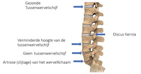 Nek En Rugklachten Dr David Van Schaik