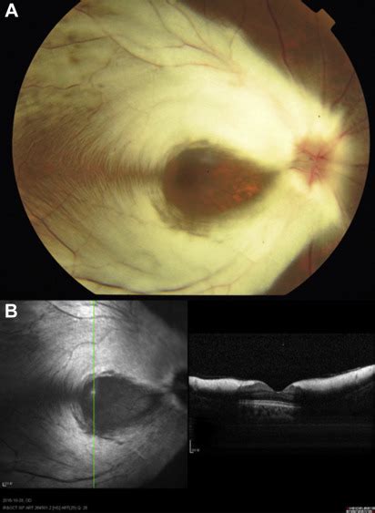 Large Area Of Myelinated Retinal Nerve Fibers Ophthalmology