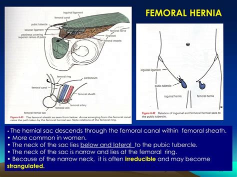 Femoral Hernia Diagram