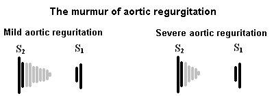 Aortic Regurgitation Topic Review | LearntheHeart.com