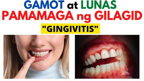 Gamot Sa Pamamaga Ng Ngipin Sakahala