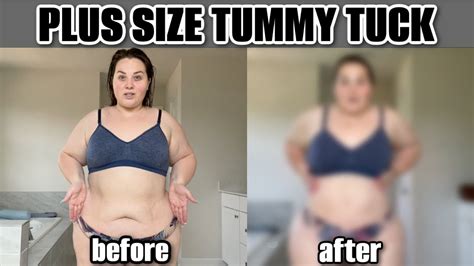 Before After A Plus Size Tummy Tuck Dr Repta Youtube