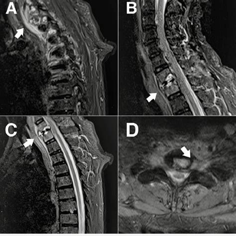 Sagittal T2 Weighted Magnetic Resonance Image Mri A Increased