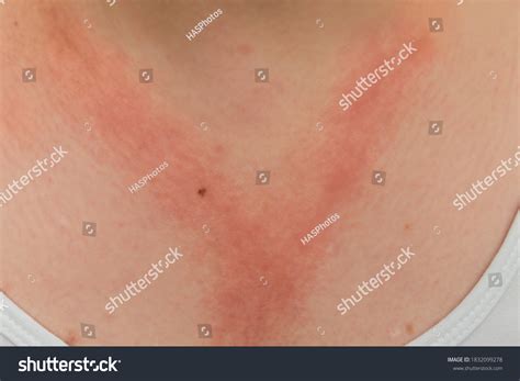 1 Imágenes De White Lady Allergic Contact Dermatitis Red Rash On Chest Neck Reaction Nickel