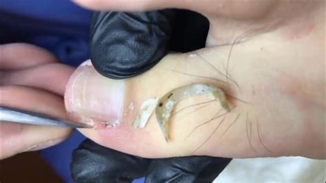 Ingrown Toenail Removal Toenail Cleaning Nail Repair E0007 YouTube