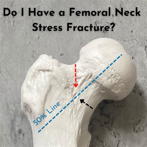 Do I Have a Femoral Neck Stress Fracture? - Nathan Carlson - Running Mate