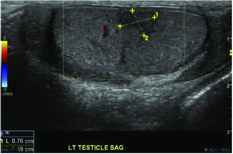 Us Of The Testis Showing L Testicular Abscess Measuring 25 × 16cm Download Scientific Diagram