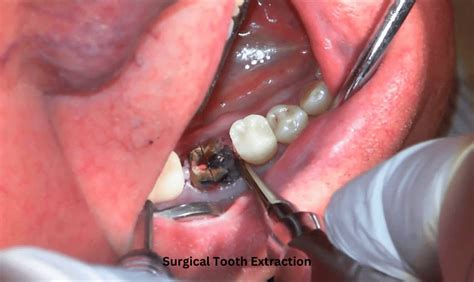 Pulling A Molar Tooth