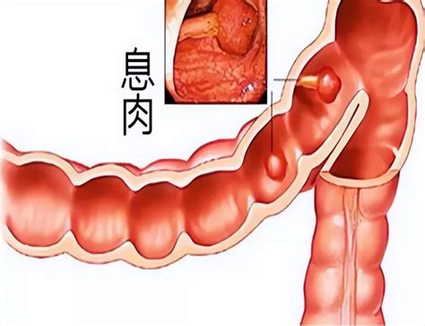 为什么肠道容易长“息肉”？肠内若有息肉，身体会有什么症状？腾讯新闻