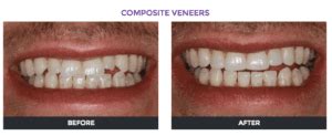 Veneers Cost In Unbiased Price Comparison By Dentists