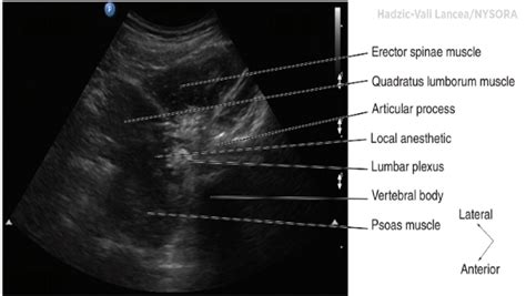 Lumbar Paravertebral Sonography And Considerations For Ultrasound